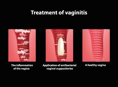 Was ist Vaginitis bei Kühen, Symptome, Behandlung