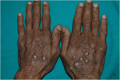 Dermatitis nodular RSC