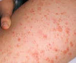 Nodulaarinen dermatiitti CRS