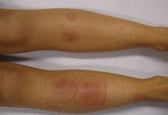 Dermatite nodulaire SRC