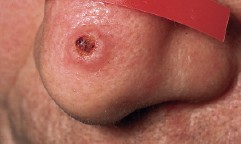 Nodulär dermatit CRS
