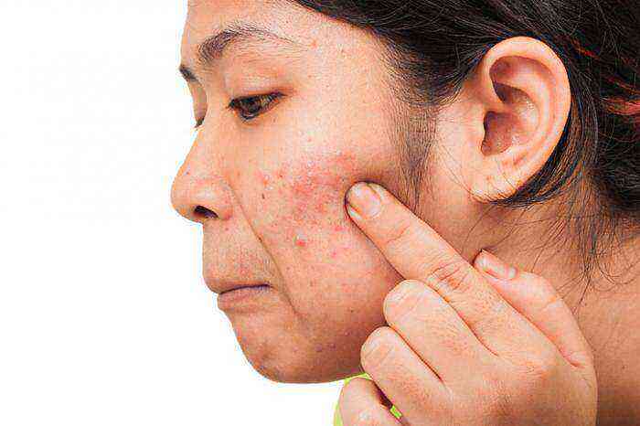 Acne benefits and harms