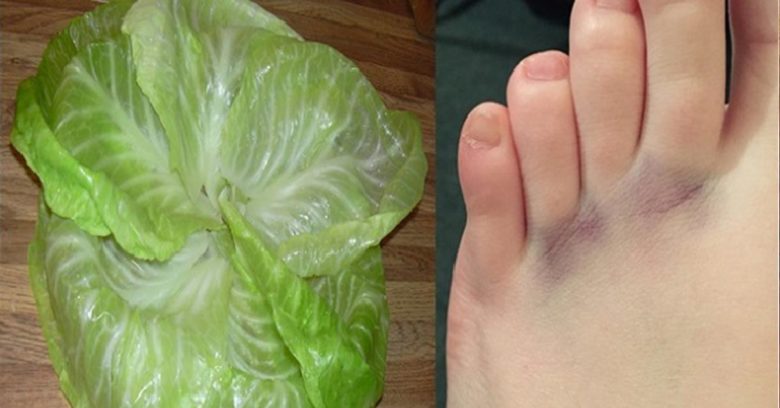 The cabbage leaf will help with bruises and bruises