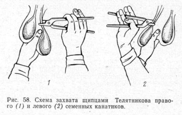 Esquema de agarre con pinzas durante la castración.