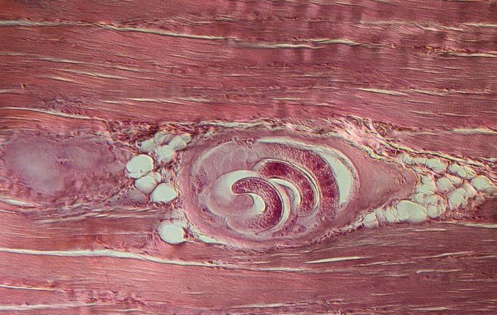 Trichinella in the muscles