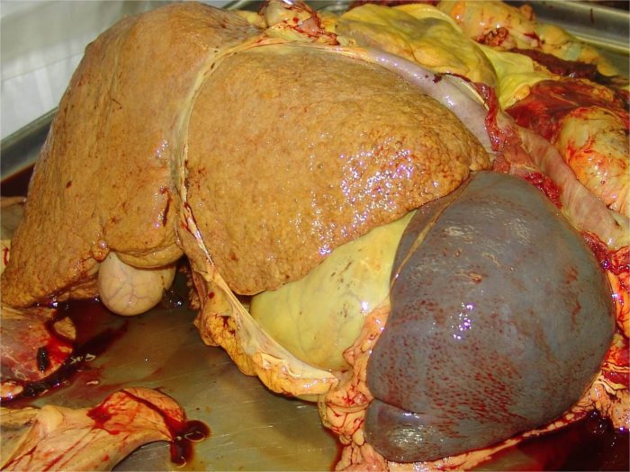 Segni di epatite nel fegato