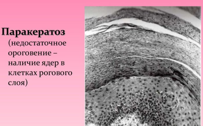 What is parakeratosis